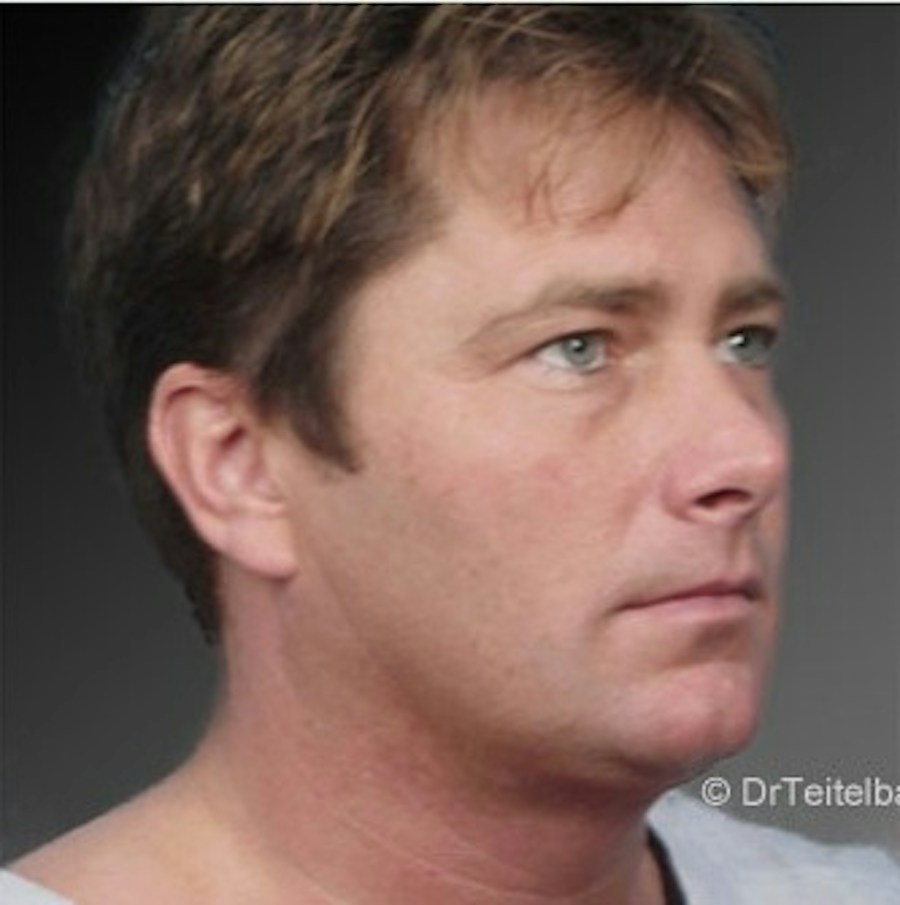 Patient 106041387 | Angle View | After | Neck Liposuction — Steven Teitelbaum MD -