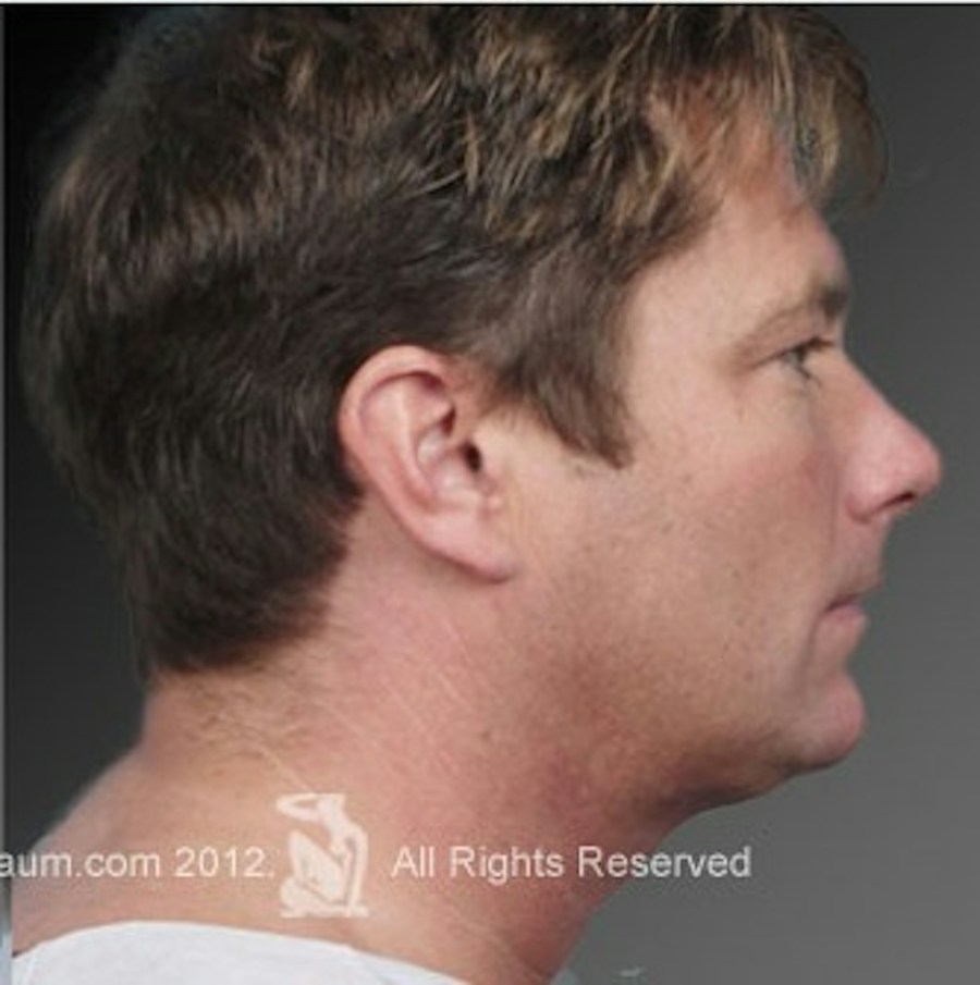 Patient 106041387 | Profile View | After | Neck Liposuction — Steven Teitelbaum MD -