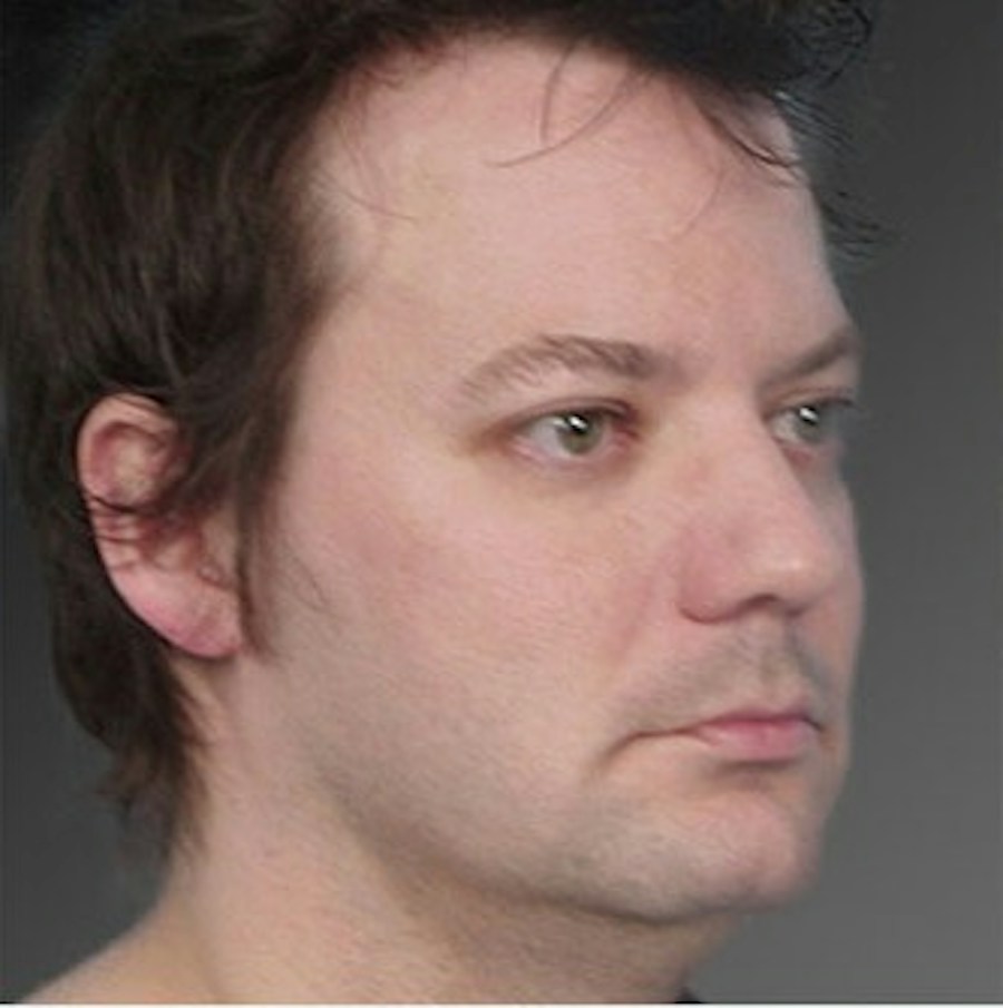 Patient 106041388 | Angle View | Before | Neck Liposuction — Steven Teitelbaum MD -