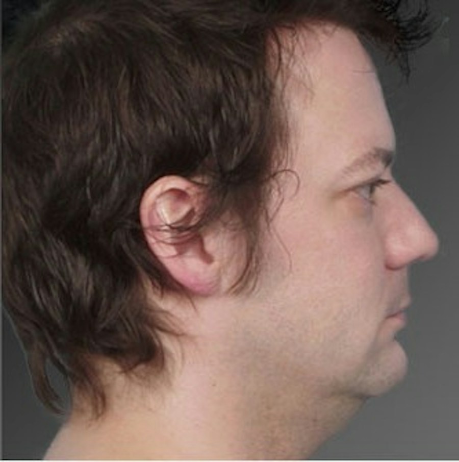 Patient 106041388 | Profile View | Before | Neck Liposuction — Steven Teitelbaum MD -