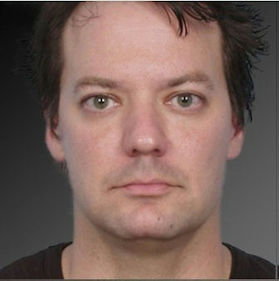 Patient 106041388 | Front View | After | Neck Liposuction — Steven Teitelbaum MD -