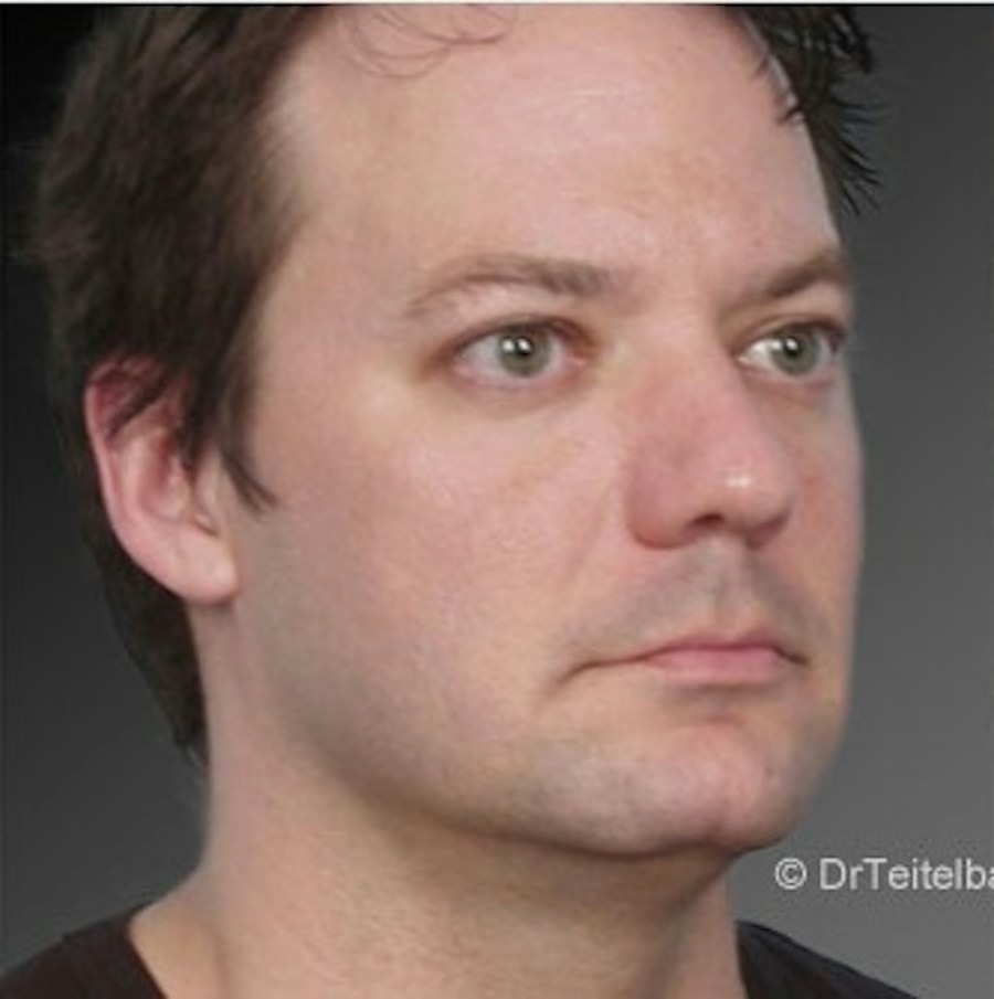 Patient 106041388 | Angle View | After | Neck Liposuction — Steven Teitelbaum MD -