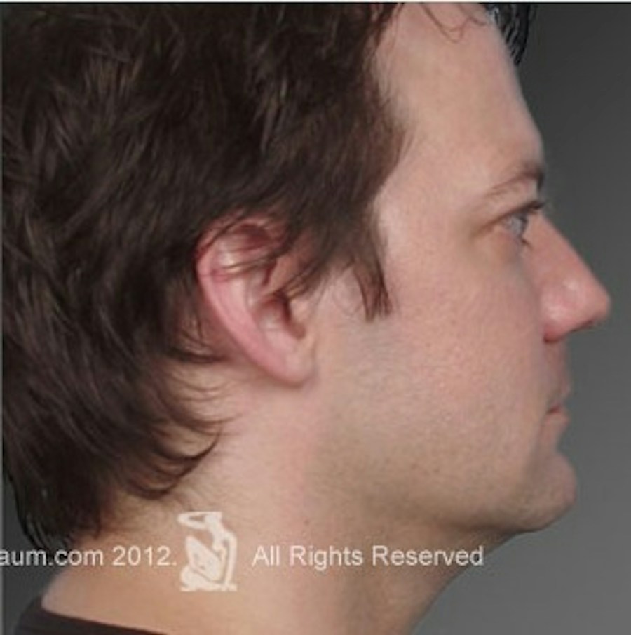 Patient 106041388 | Profile View | After | Neck Liposuction — Steven Teitelbaum MD -