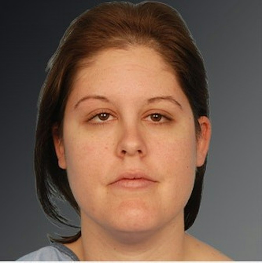 Patient 106041390 | Front View | Before | Neck Liposuction — Steven Teitelbaum MD -