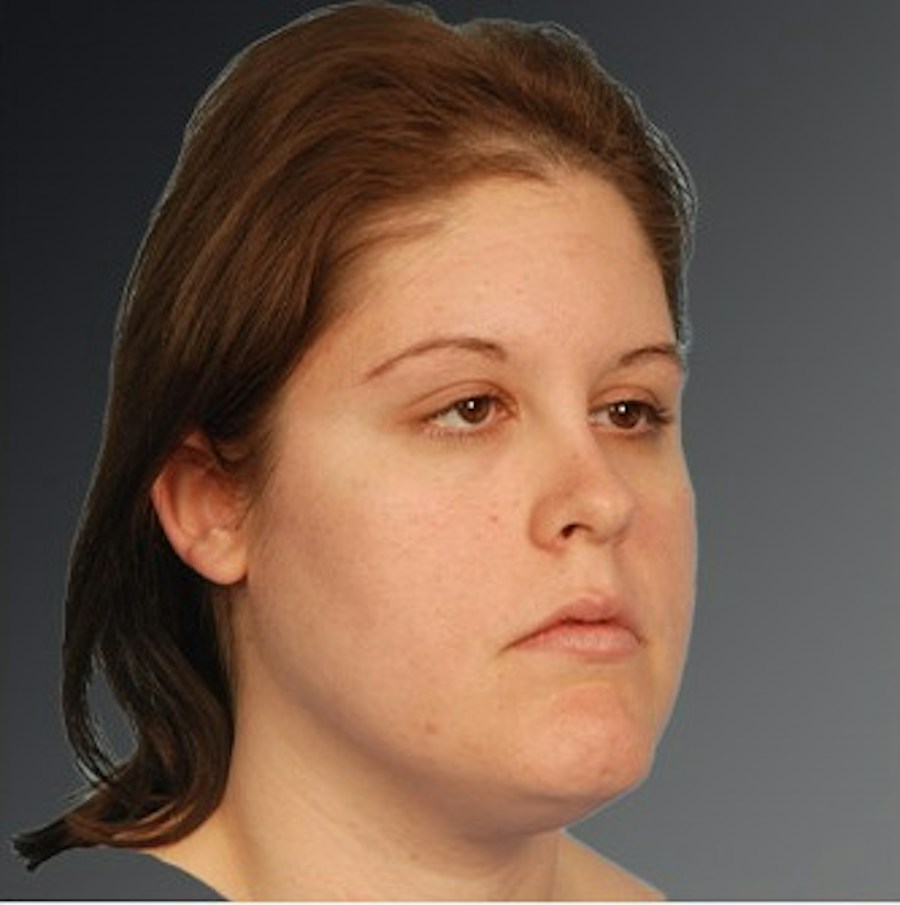 Patient 106041390 | Angle View | Before | Neck Liposuction — Steven Teitelbaum MD -