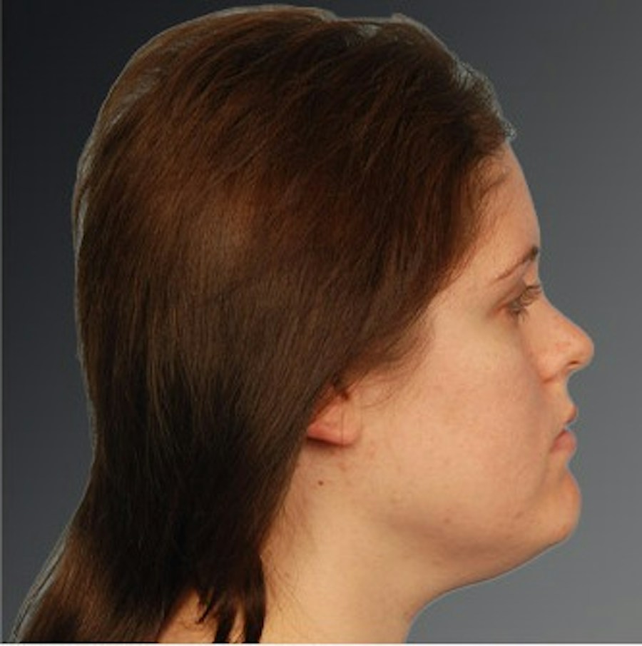 Patient 106041390 | Profile View | Before | Neck Liposuction — Steven Teitelbaum MD -