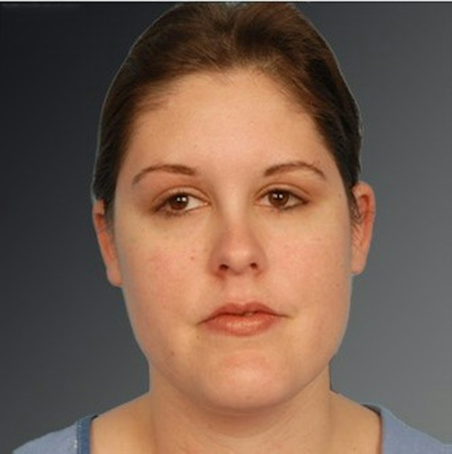 Patient 106041390 | Front View | After | Neck Liposuction — Steven Teitelbaum MD -