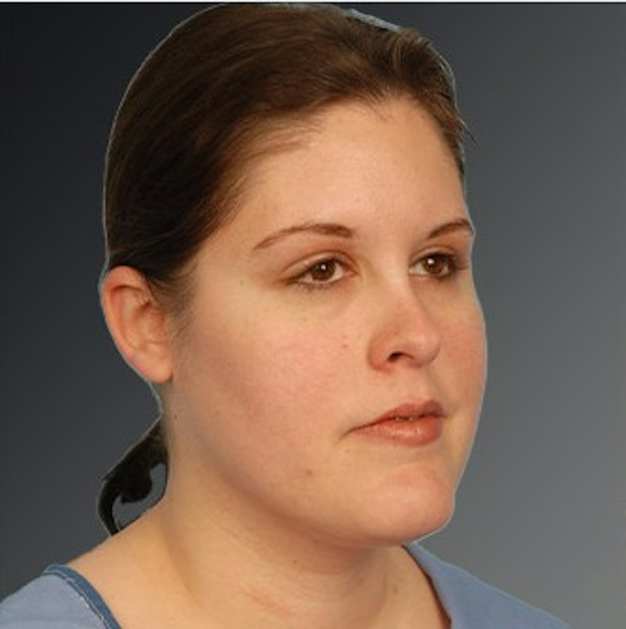 Patient 106041390 | Angle View | After | Neck Liposuction — Steven Teitelbaum MD -