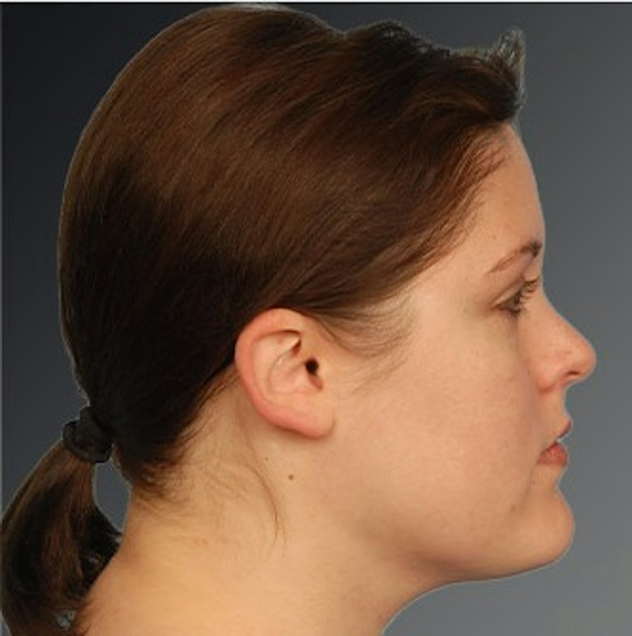 Patient 106041390 | Profile View | After | Neck Liposuction — Steven Teitelbaum MD -