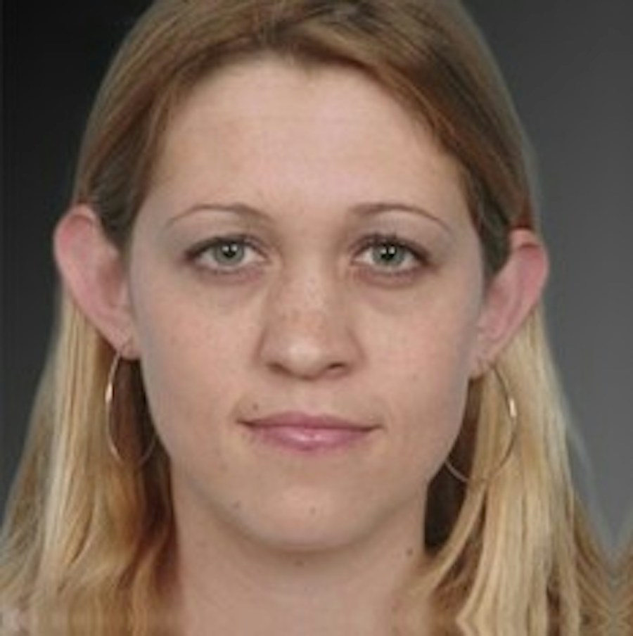 Patient 106041428 | Front View | Before | Ears (Otoplasty) — Steven Teitelbaum MD -