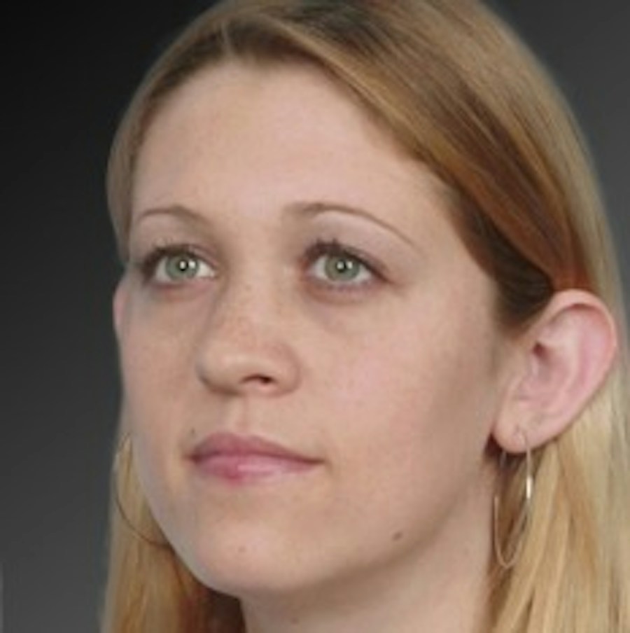 Patient 106041428 | Angle View | Before | Ears (Otoplasty) — Steven Teitelbaum MD -