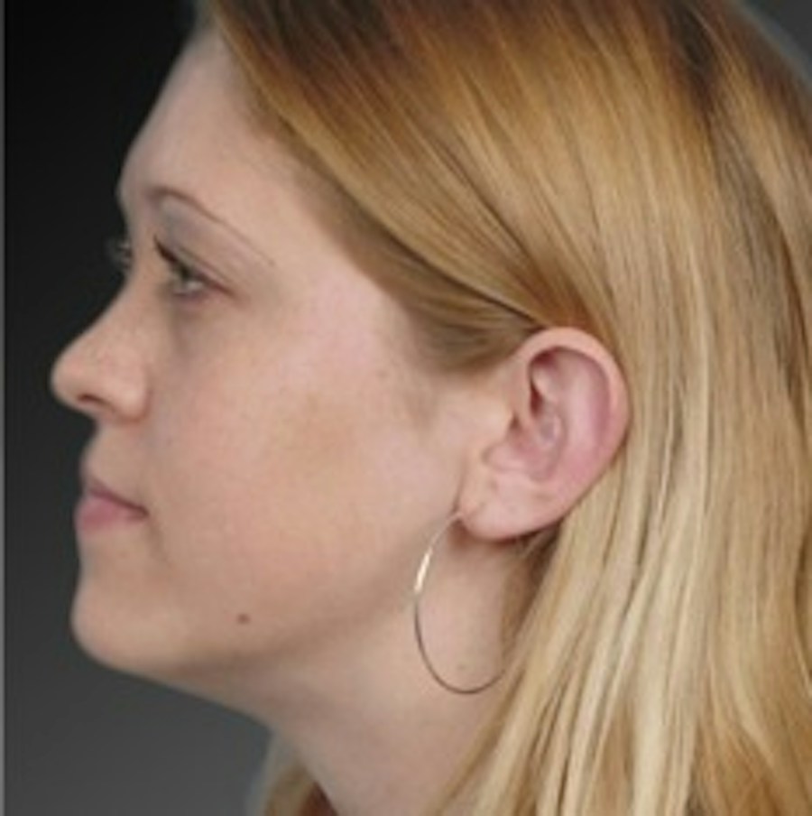 Patient 106041428 | Profile View | Before | Ears (Otoplasty) — Steven Teitelbaum MD -