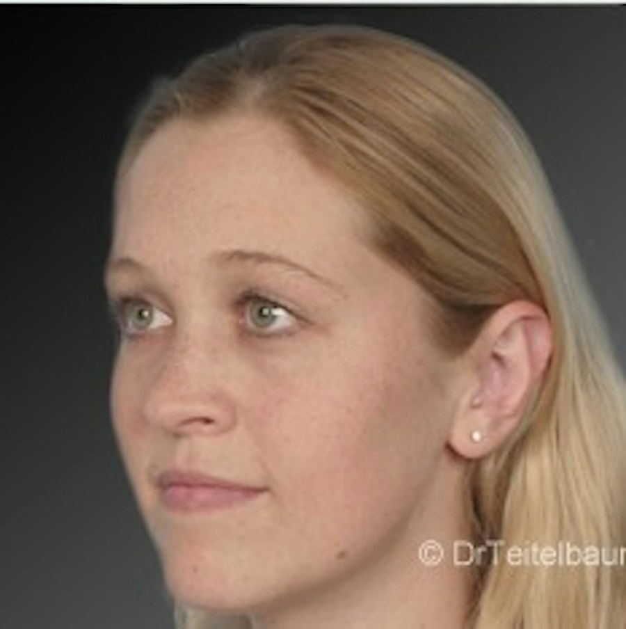 Patient 106041428 | Angle View | After | Ears (Otoplasty) — Steven Teitelbaum MD -