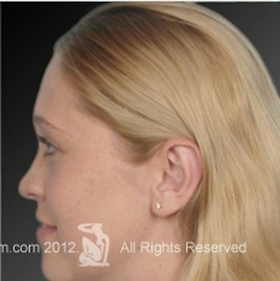 Patient 106041428 | Profile View | After | Ears (Otoplasty) — Steven Teitelbaum MD -