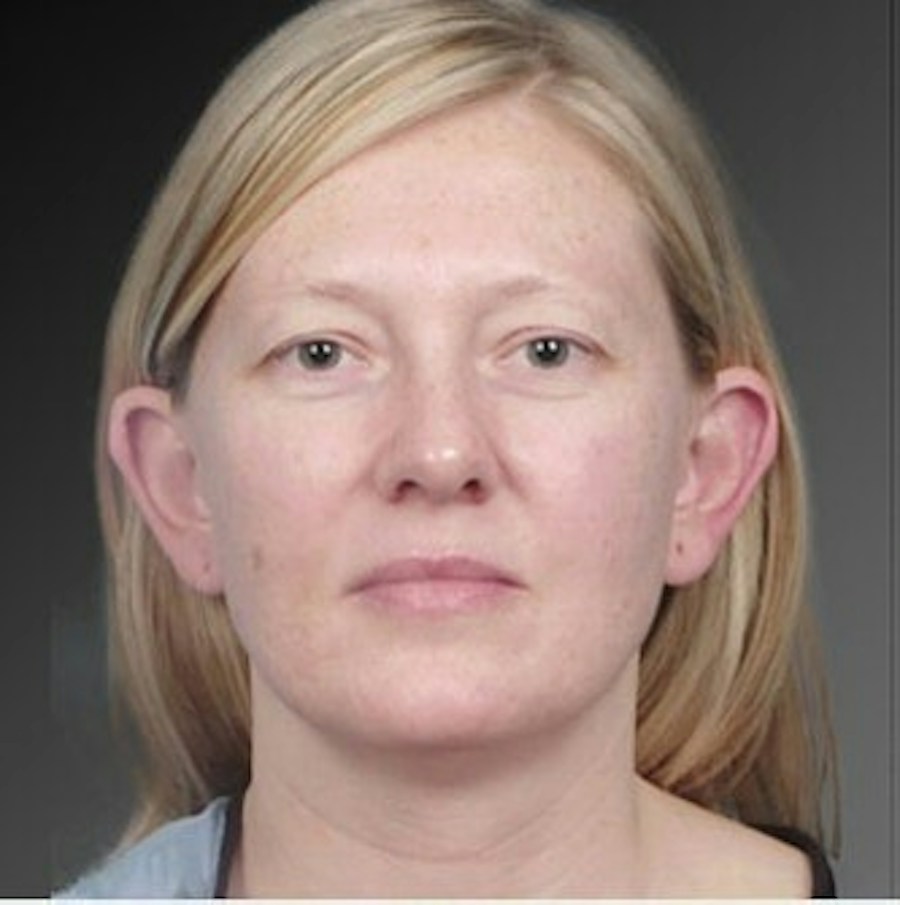 Patient 106041429 | Front View | Before | Ears (Otoplasty) — Steven Teitelbaum MD -