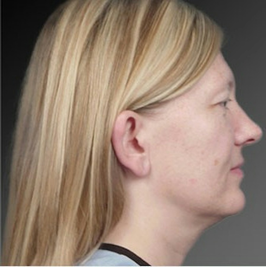 Patient 106041429 | Profile View | Before | Ears (Otoplasty) — Steven Teitelbaum MD -