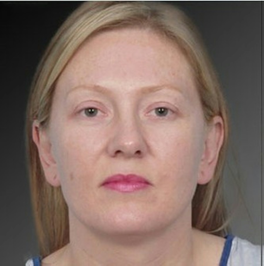 Patient 106041429 | Front View | After | Ears (Otoplasty) — Steven Teitelbaum MD -