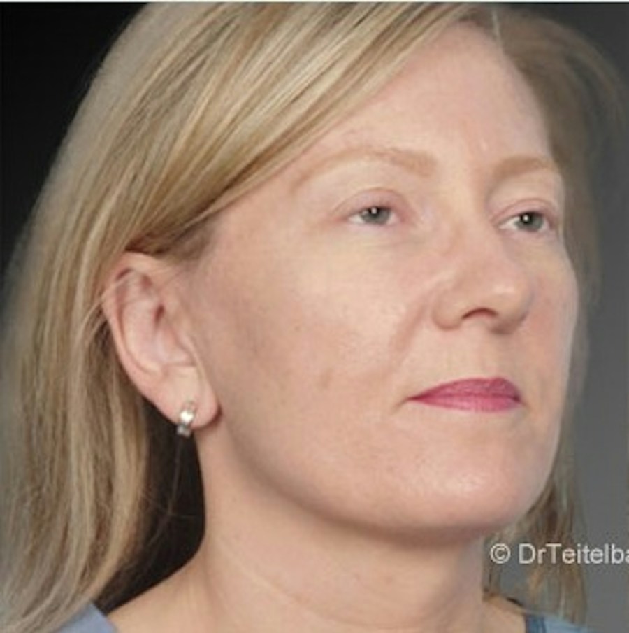 Patient 106041429 | Angle View | After | Ears (Otoplasty) — Steven Teitelbaum MD -