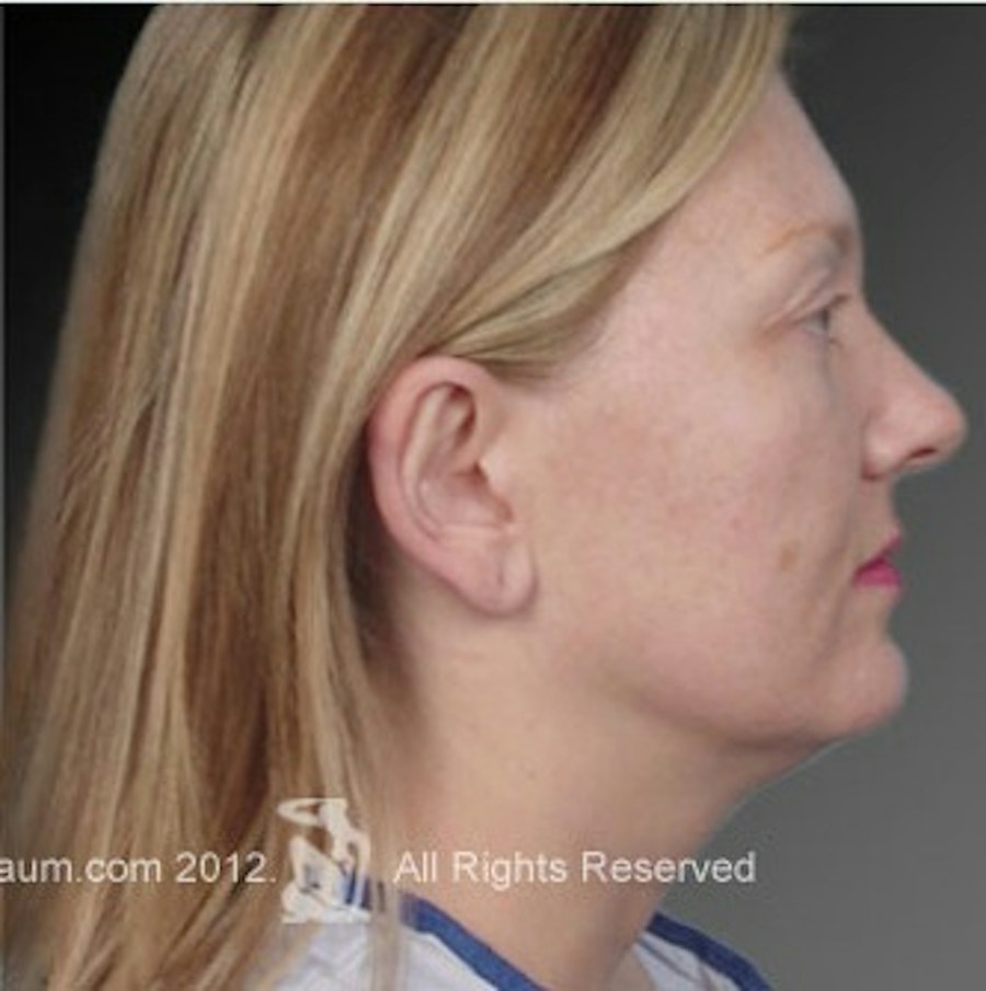 Patient 106041429 | Profile View | After | Ears (Otoplasty) — Steven Teitelbaum MD -