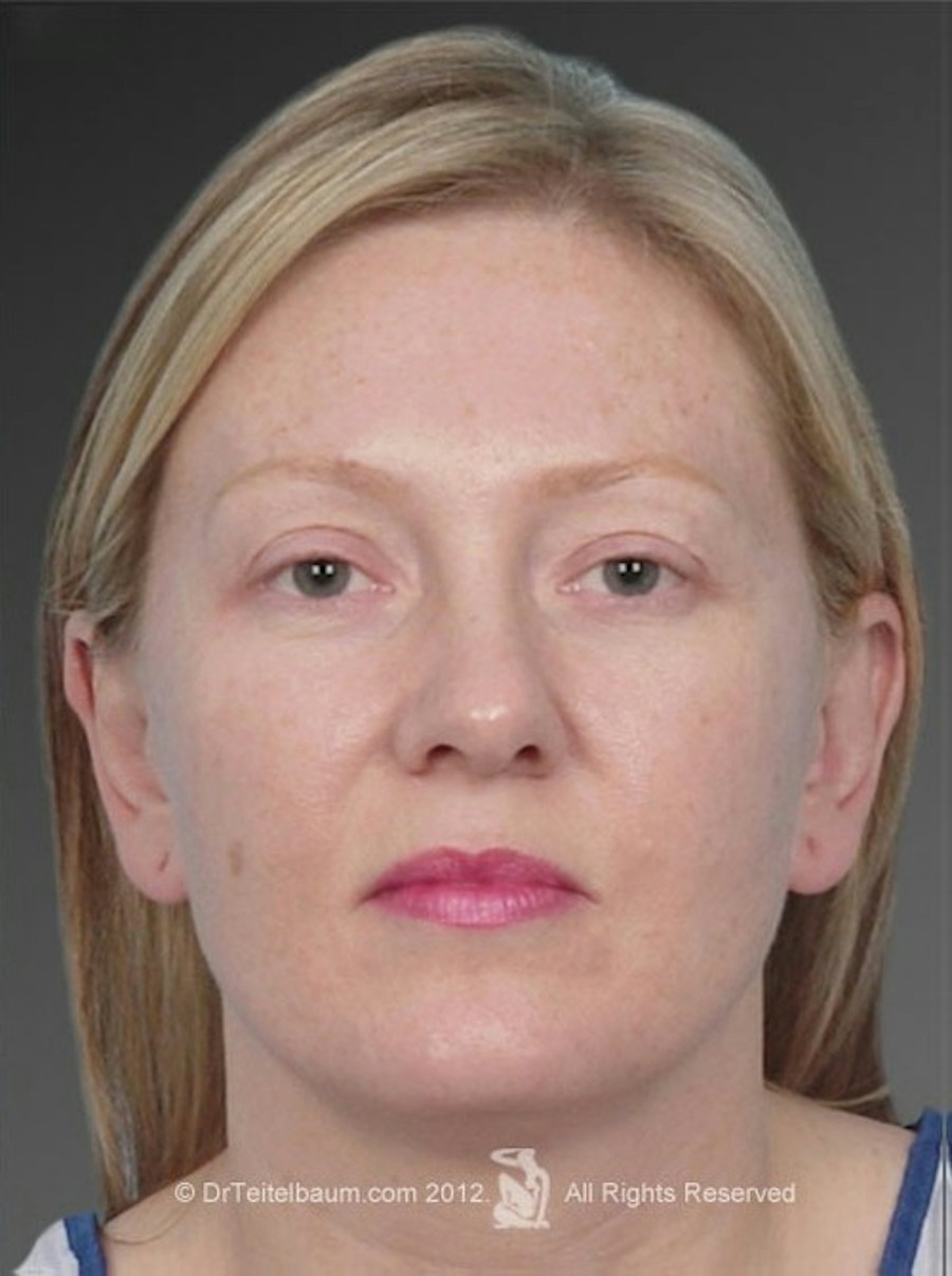 Patient 106041430 | Front View | After | Ears (Otoplasty) — Steven Teitelbaum MD - Santa Monica