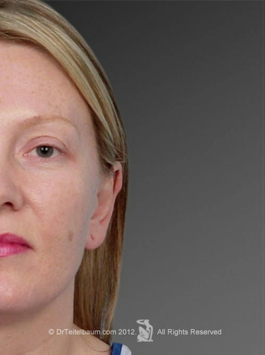 Patient 106041431 | Front View | After | Ears (Otoplasty) — Steven Teitelbaum MD - Santa Monica