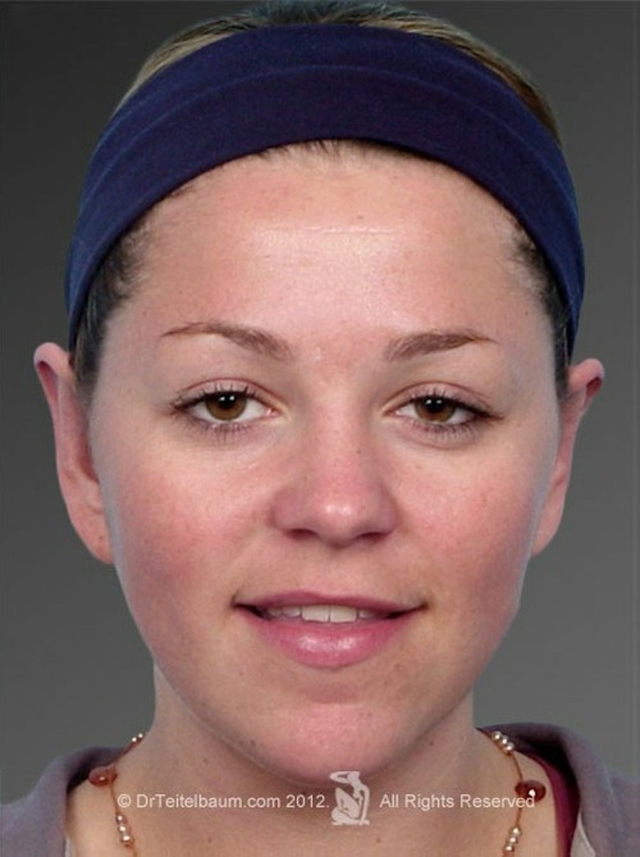 Patient 106041432 | Front View | After | Ears (Otoplasty) — Steven Teitelbaum MD - Santa Monica