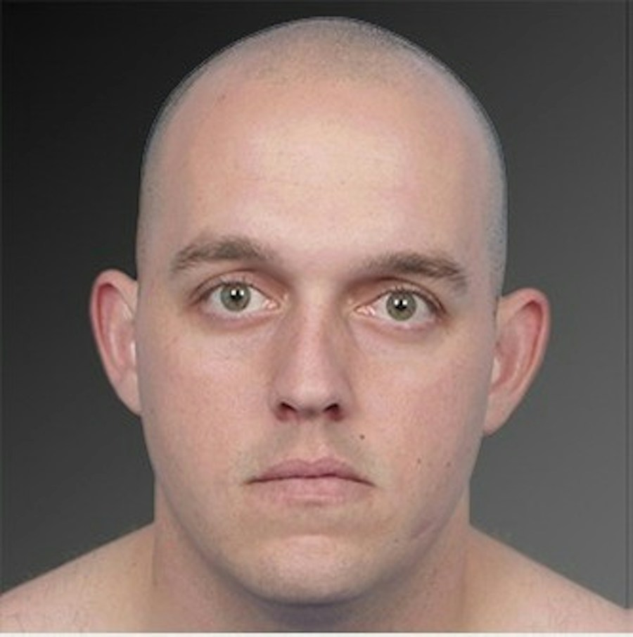 Patient 106041433 | Front View | Before | Ears (Otoplasty) — Steven Teitelbaum MD -