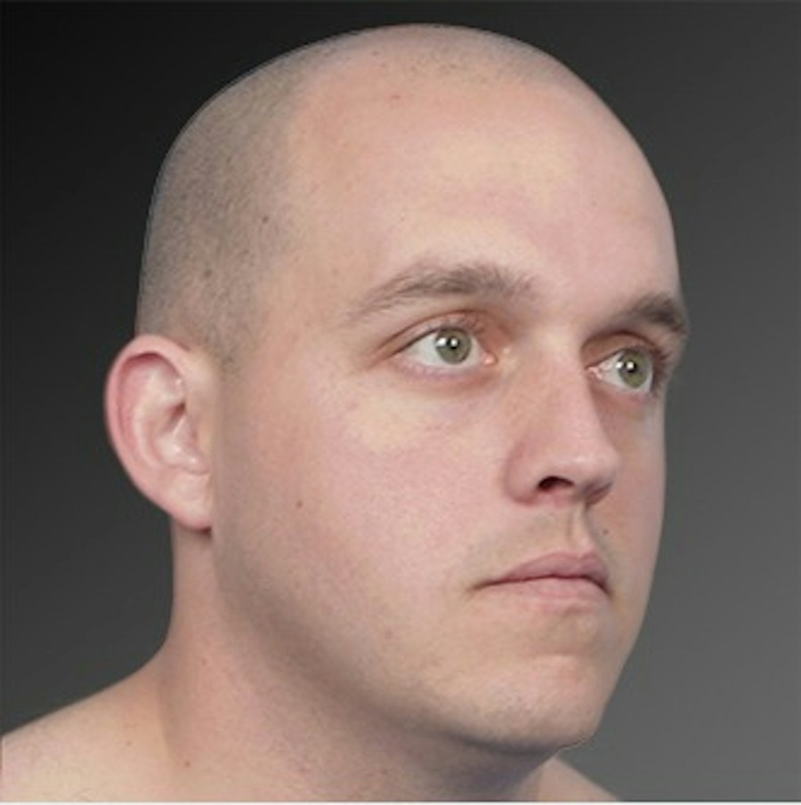 Patient 106041433 | Angle View | Before | Ears (Otoplasty) — Steven Teitelbaum MD -