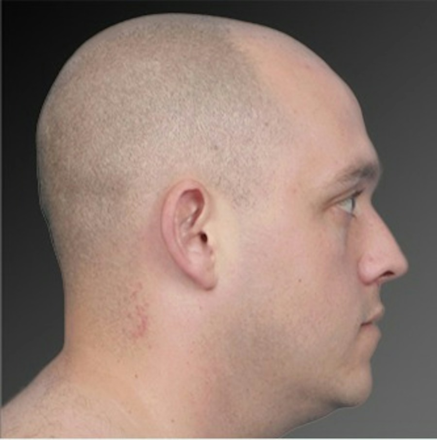 Patient 106041433 | Profile View | Before | Ears (Otoplasty) — Steven Teitelbaum MD -