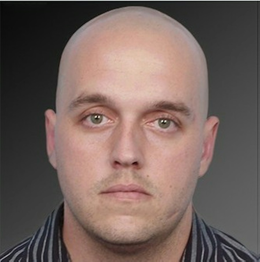 Patient 106041433 | Front View | After | Ears (Otoplasty) — Steven Teitelbaum MD -