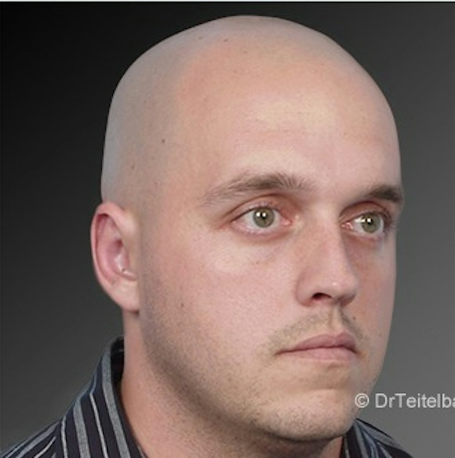 Patient 106041433 | Angle View | After | Ears (Otoplasty) — Steven Teitelbaum MD -