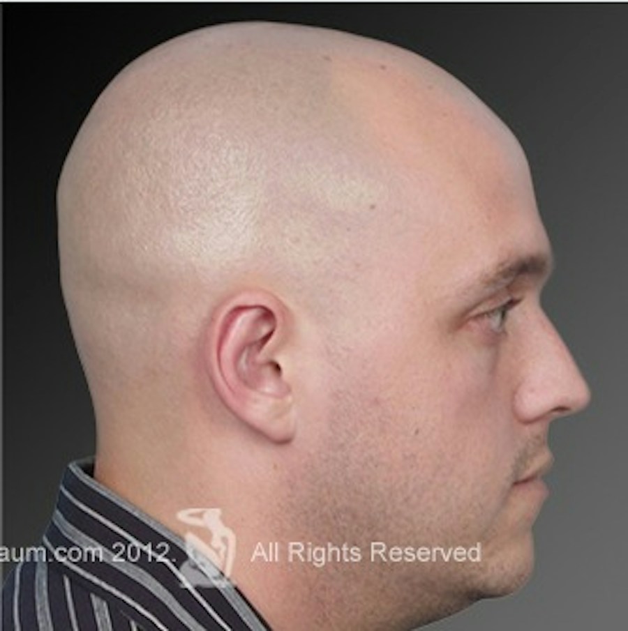 Patient 106041433 | Profile View | After | Ears (Otoplasty) — Steven Teitelbaum MD -