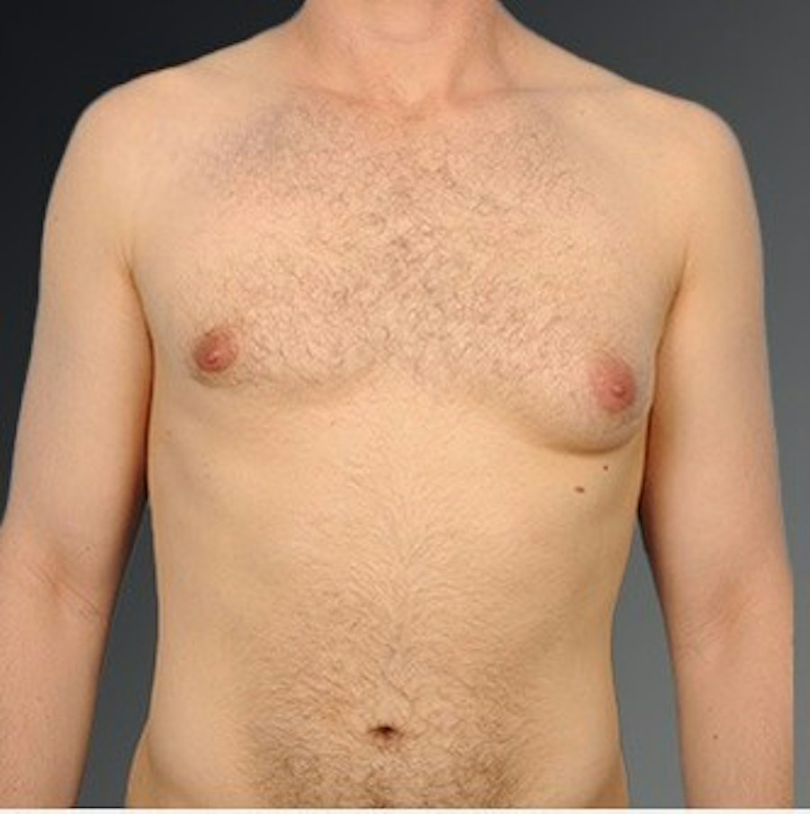 Patient 106041440 | Front View | Before | Chest (Gynecomastia) — Steven Teitelbaum MD -