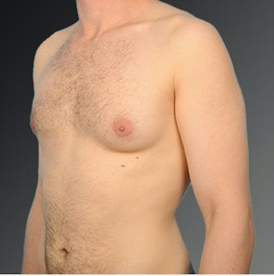 Patient 106041440 | Angle View | Before | Chest (Gynecomastia) — Steven Teitelbaum MD -