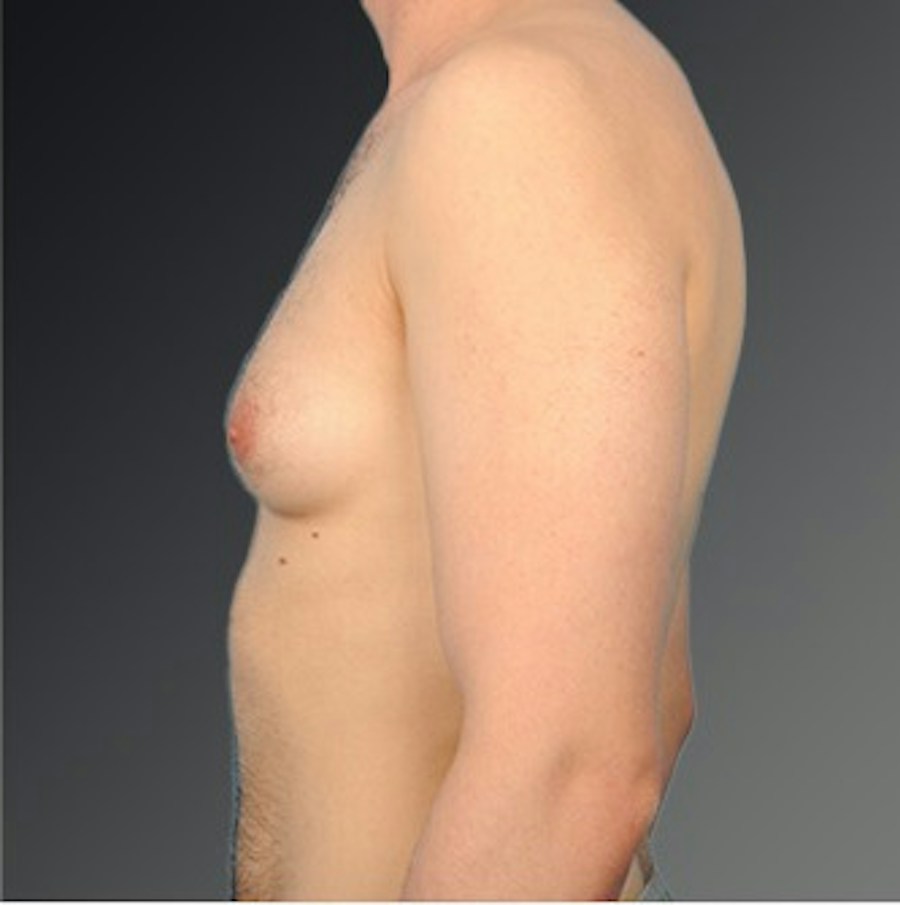 Patient 106041440 | Profile View | Before | Chest (Gynecomastia) — Steven Teitelbaum MD -