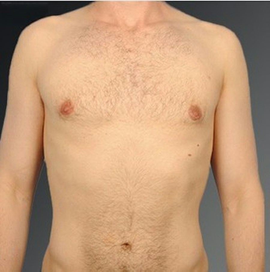 Patient 106041440 | Front View | After | Chest (Gynecomastia) — Steven Teitelbaum MD -