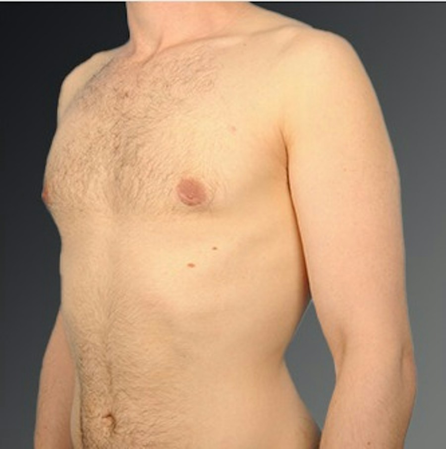 Patient 106041440 | Angle View | After | Chest (Gynecomastia) — Steven Teitelbaum MD -