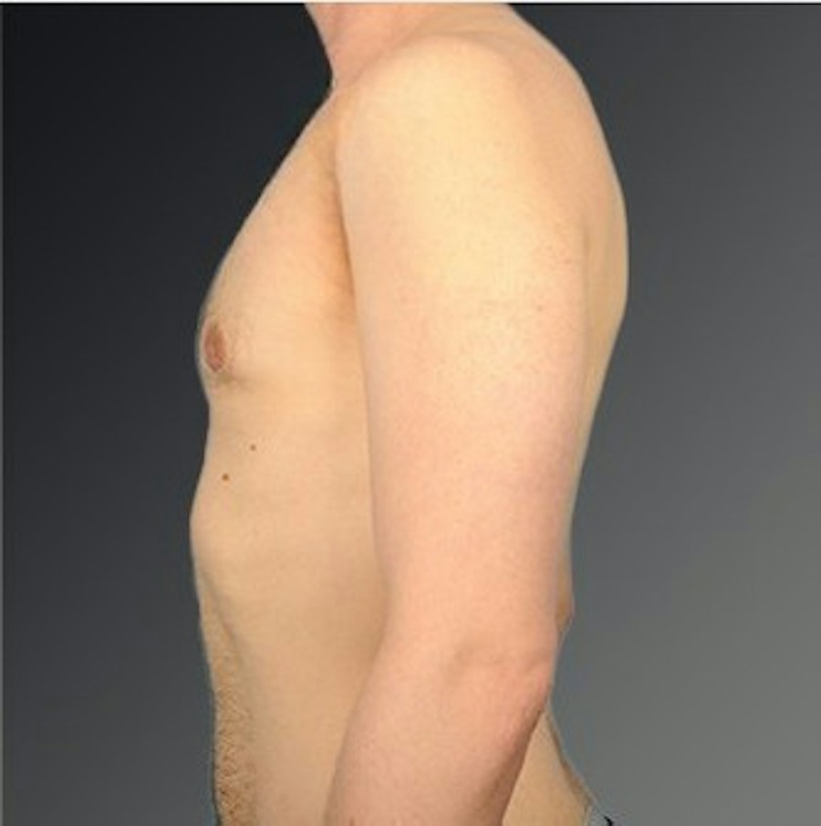 Patient 106041440 | Profile View | After | Chest (Gynecomastia) — Steven Teitelbaum MD -