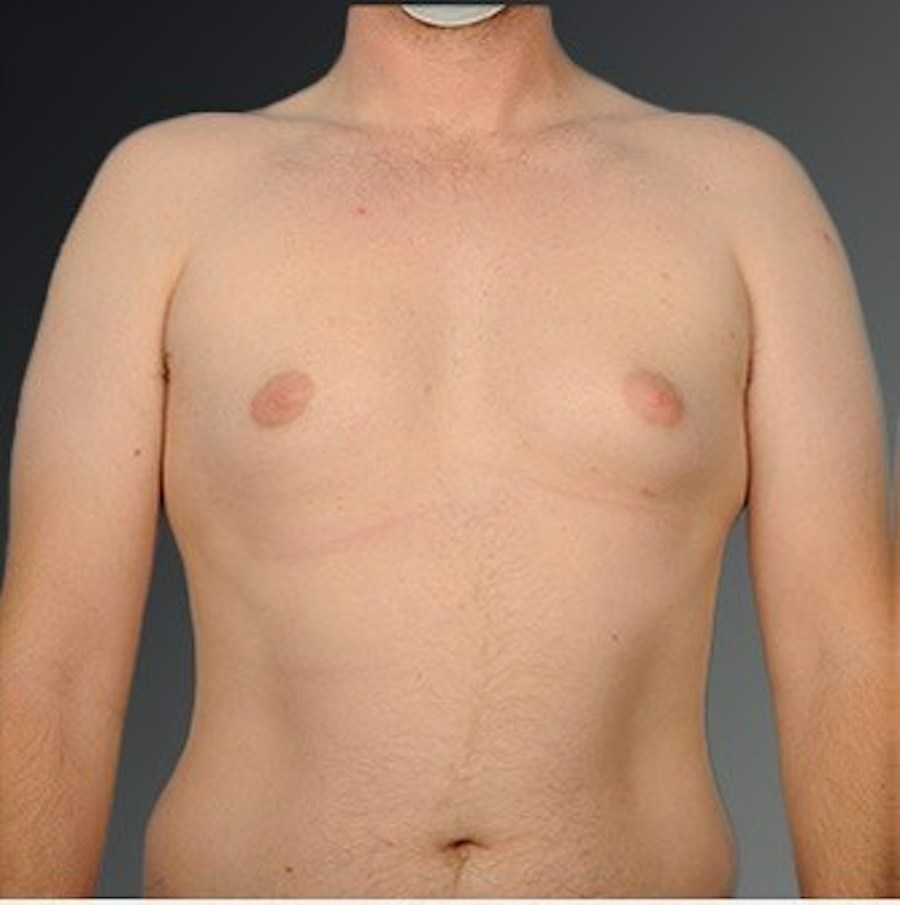 Patient 106041443 | Front View | Before | Chest (Gynecomastia) — Steven Teitelbaum MD -