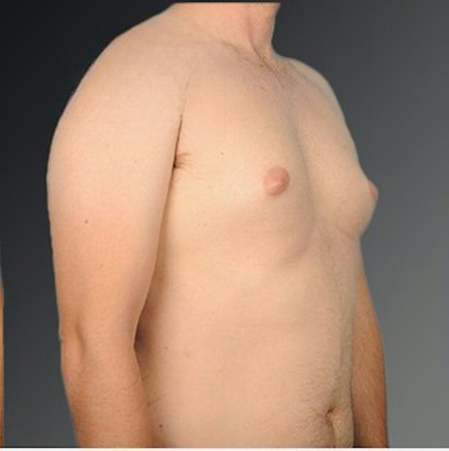 Patient 106041443 | Angle View | Before | Chest (Gynecomastia) — Steven Teitelbaum MD -