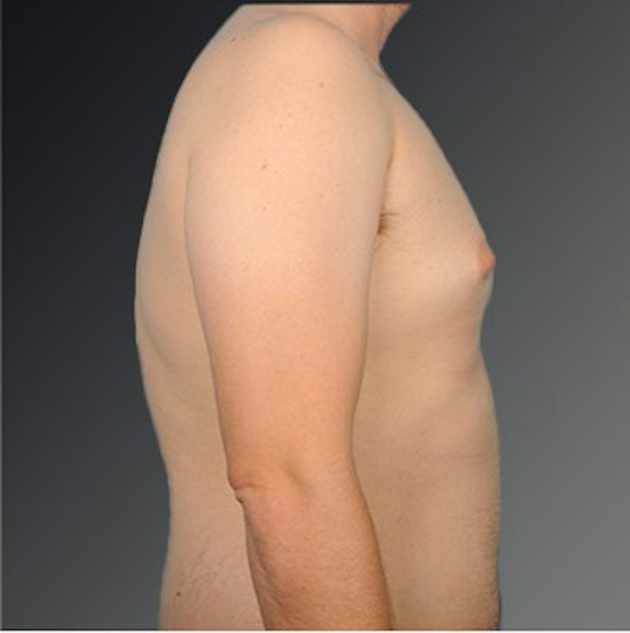 Patient 106041443 | Profile View | Before | Chest (Gynecomastia) — Steven Teitelbaum MD -
