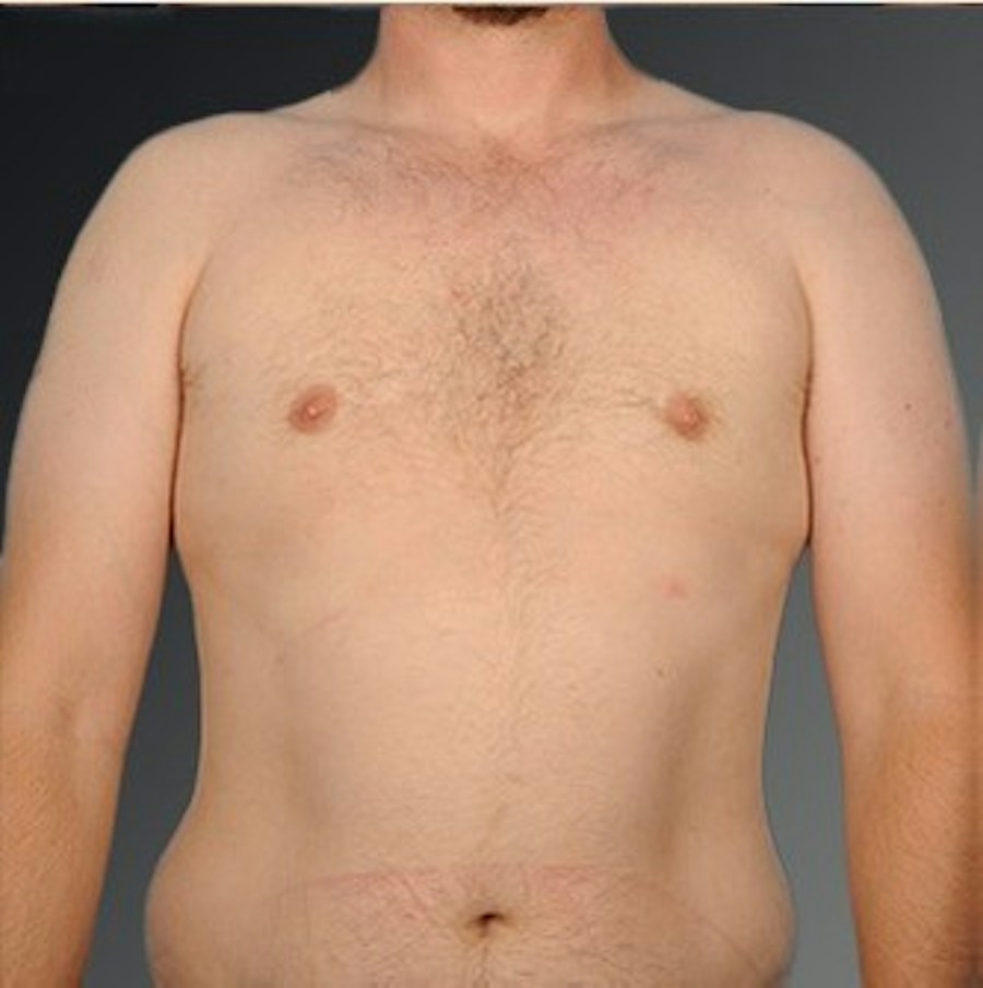 Patient 106041443 | Front View | After | Chest (Gynecomastia) — Steven Teitelbaum MD -