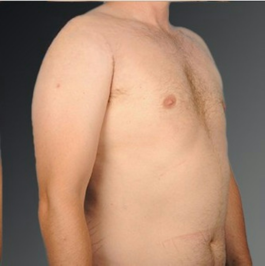 Patient 106041443 | Angle View | After | Chest (Gynecomastia) — Steven Teitelbaum MD -