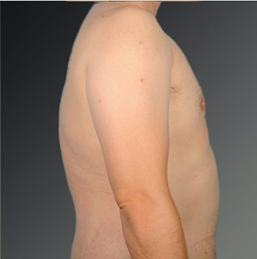 Patient 106041443 | Profile View | After | Chest (Gynecomastia) — Steven Teitelbaum MD -