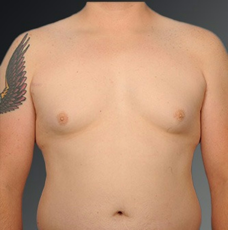 Patient 106041444 | Front View | Before | Chest (Gynecomastia) — Steven Teitelbaum MD -