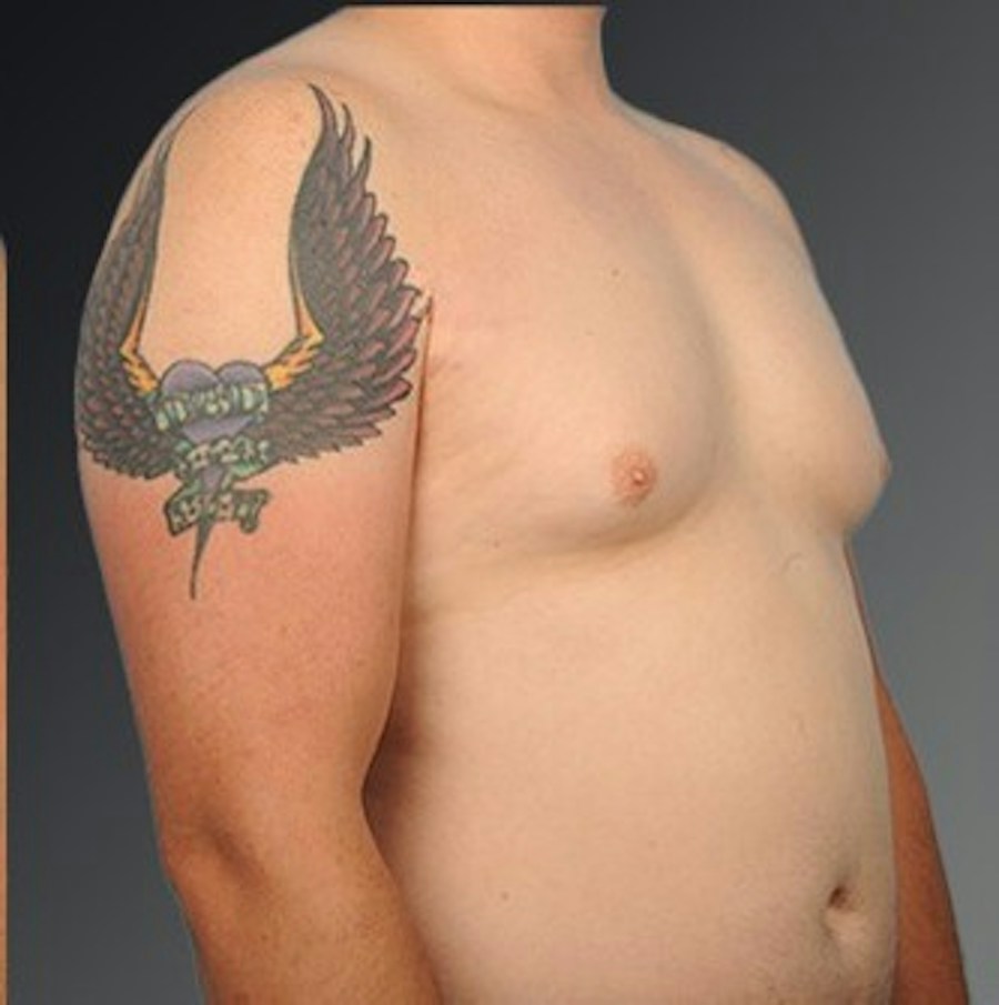 Patient 106041444 | Angle View | Before | Chest (Gynecomastia) — Steven Teitelbaum MD -