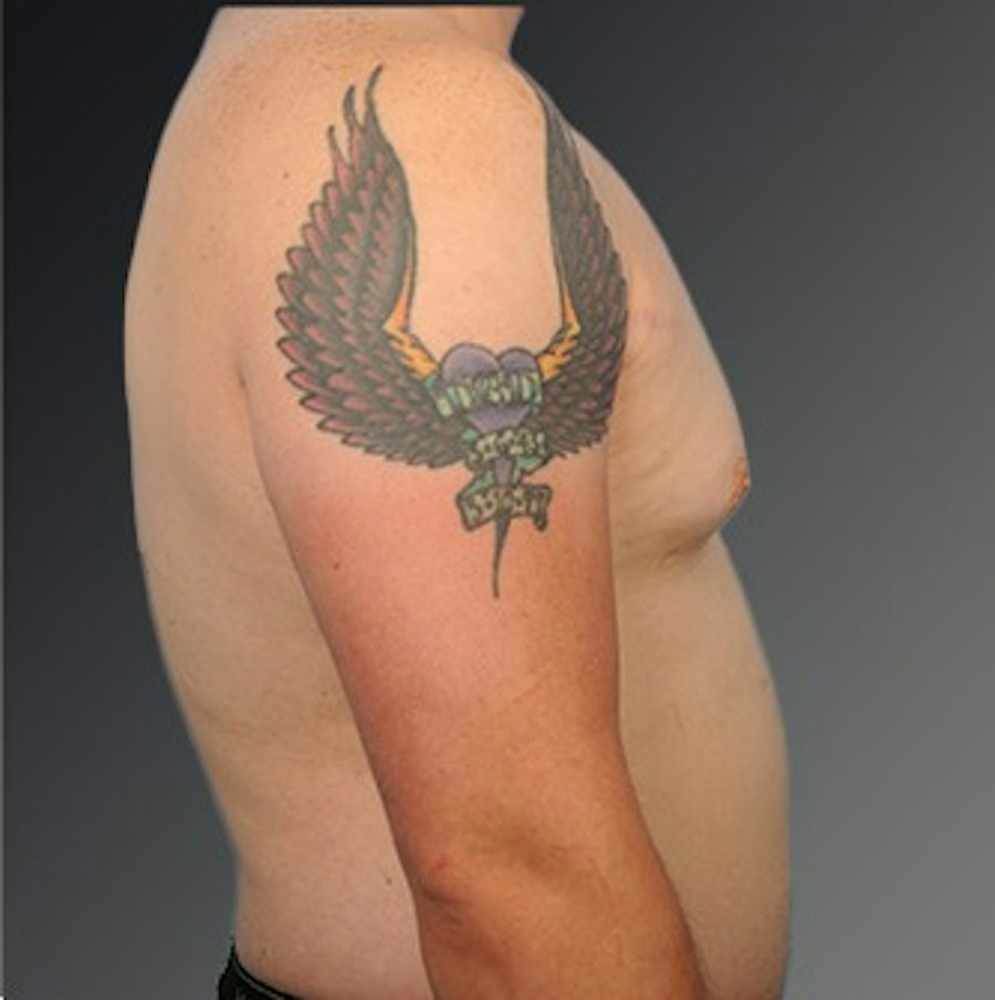 Patient 106041444 | Profile View | Before | Chest (Gynecomastia) — Steven Teitelbaum MD -