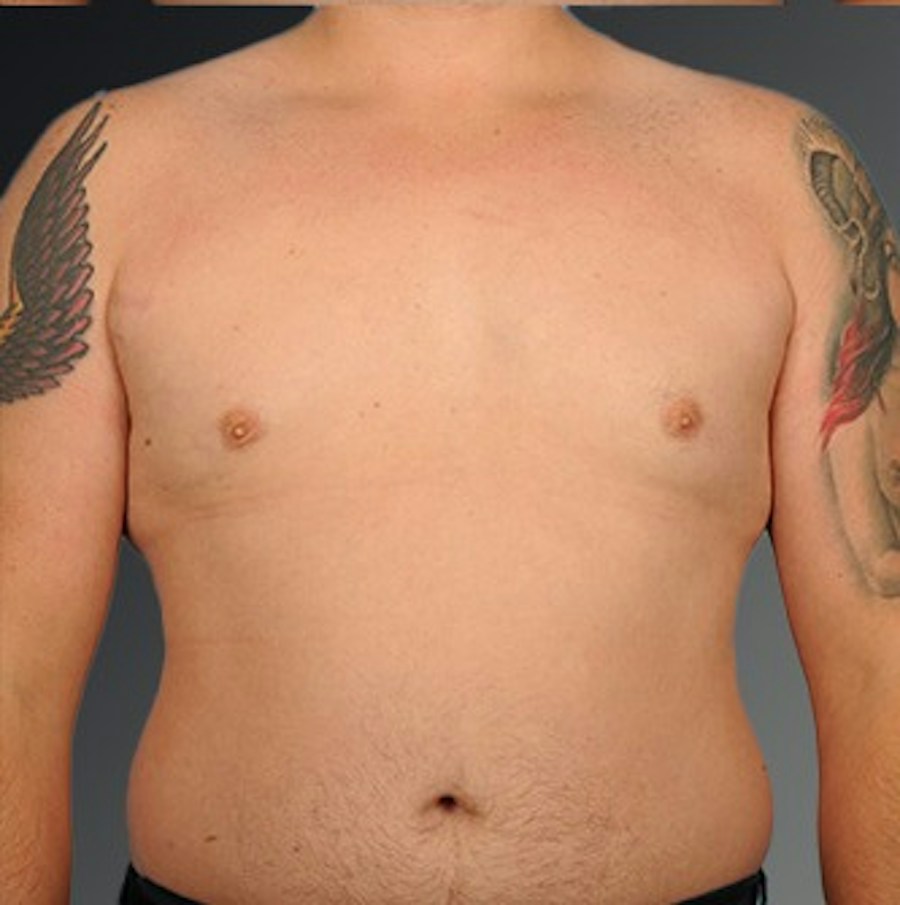 Patient 106041444 | Front View | After | Chest (Gynecomastia) — Steven Teitelbaum MD - Santa Monica