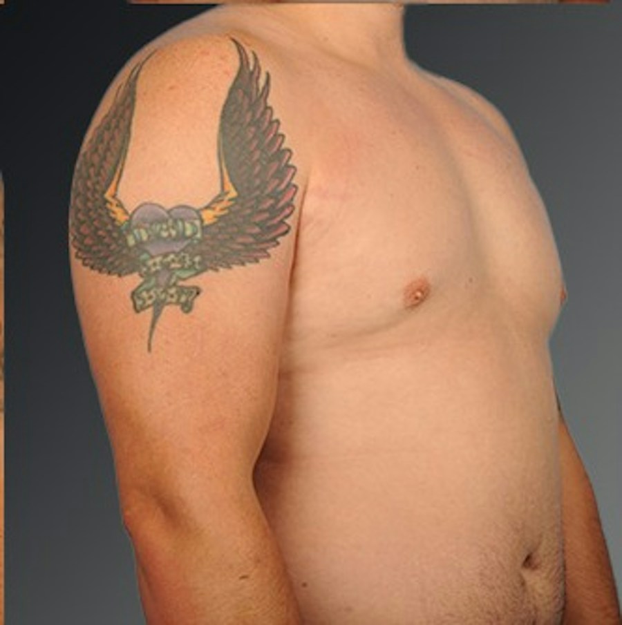 Patient 106041444 | Angle View | After | Chest (Gynecomastia) — Steven Teitelbaum MD -