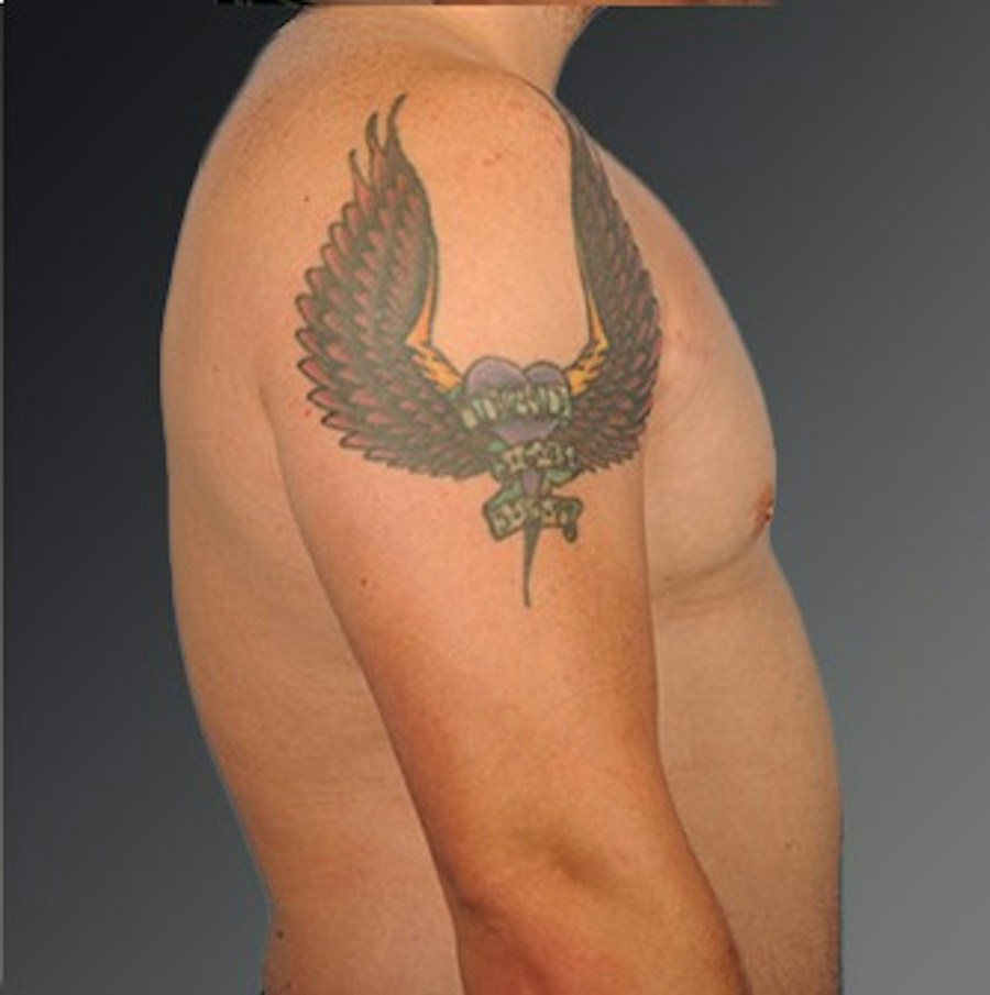 Patient 106041444 | Profile View | After | Chest (Gynecomastia) — Steven Teitelbaum MD -